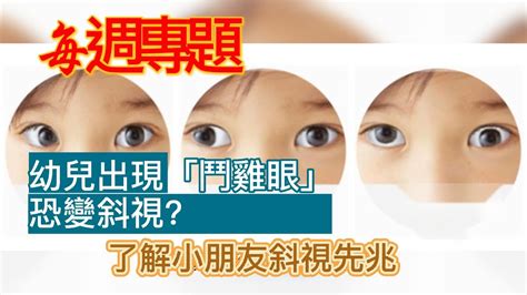 幼兒斜眼看人|了解嬰幼兒斜視原因及治療方法